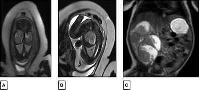 Fetal Wilm's tumor detection preceding the development of isolated lateralized overgrowth of the limb: a case report and review of literature